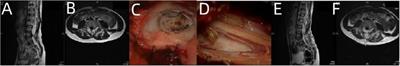 Classification of and individual treatment strategies for complex tethered cord syndrome